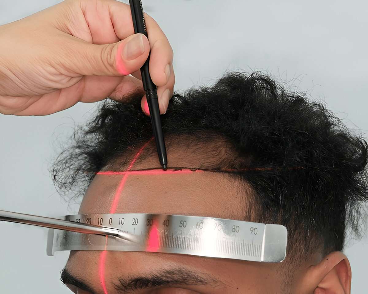 best hair transplant London