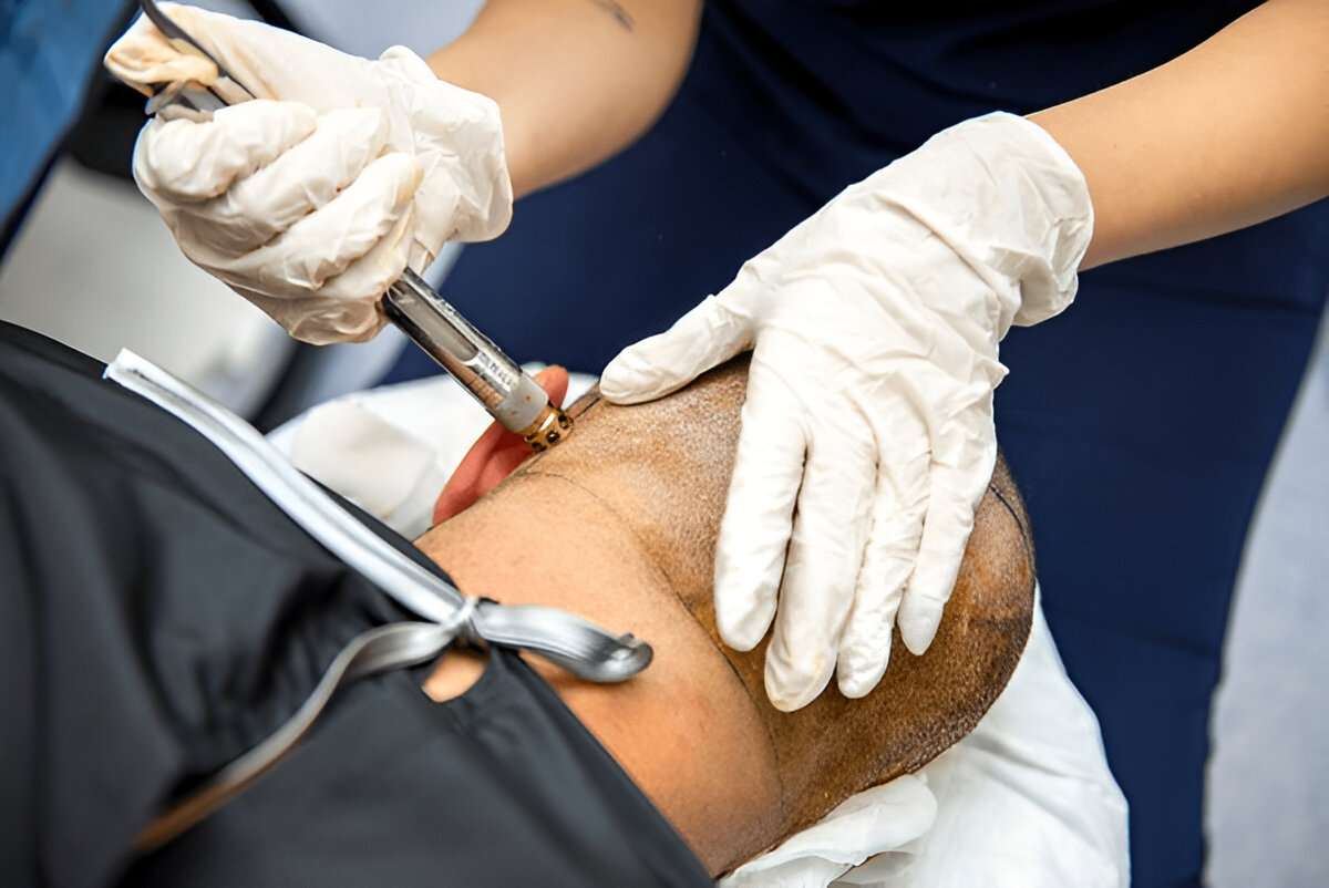 Best hair transplant UK