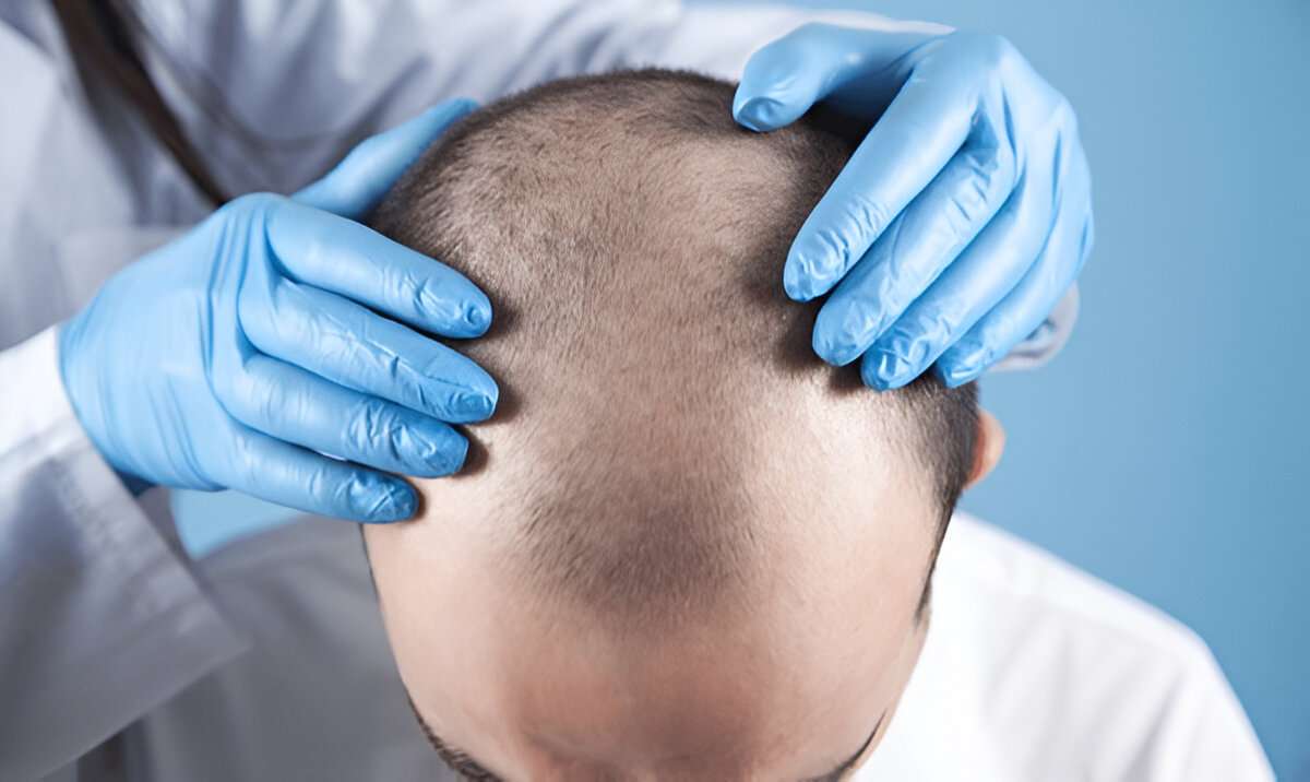 Understanding the Hair Transplant Consultation Process in London