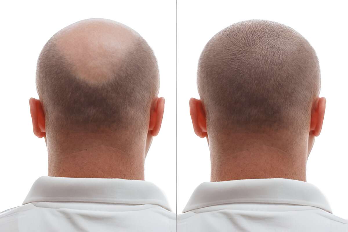 Hair Transplant