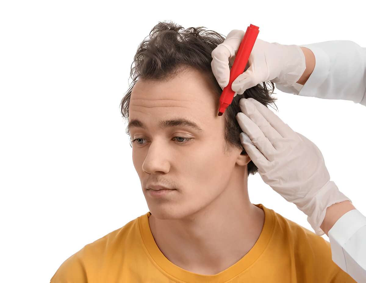 Hair Transplant
