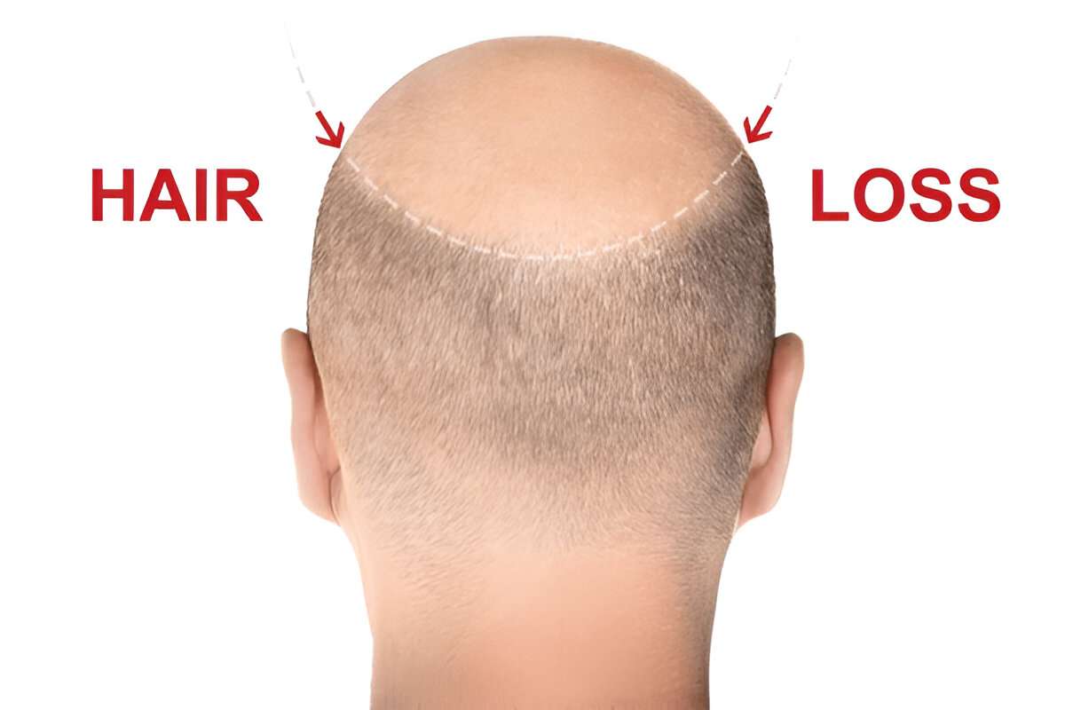 Hair Transplant
