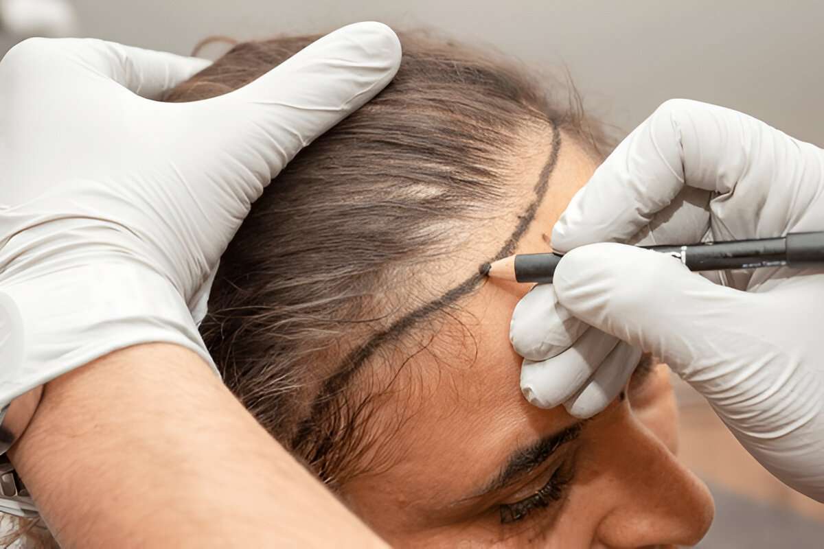 Hair Transplant