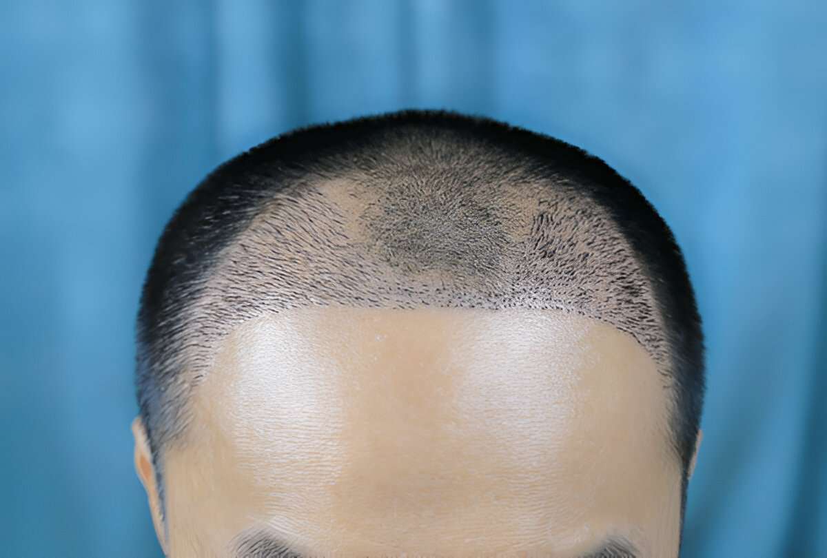manual hair transplant