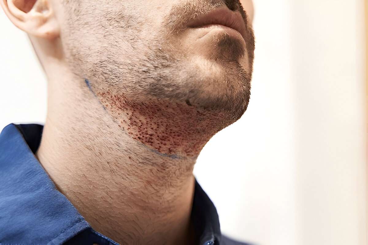 hair transplant cost