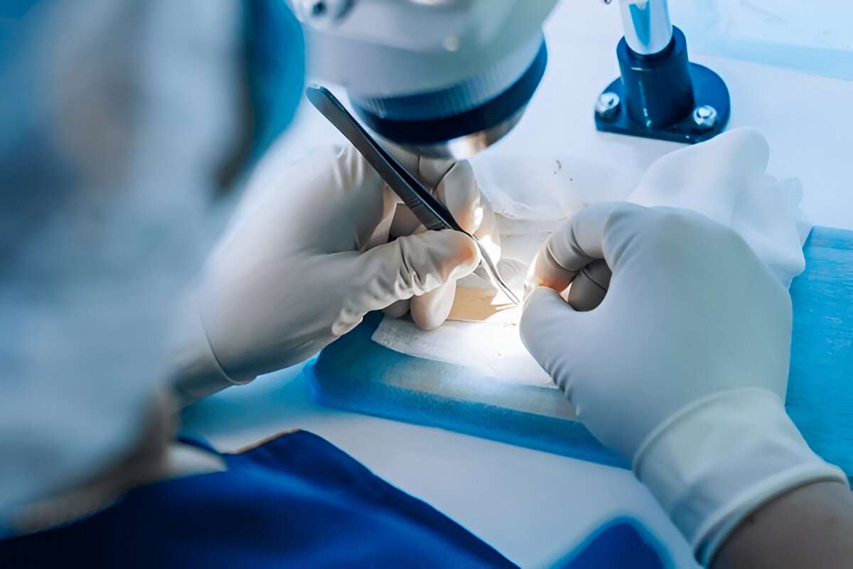hair transplant Bristol
