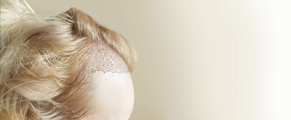 hair transplant London