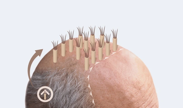 hair loss treatment men