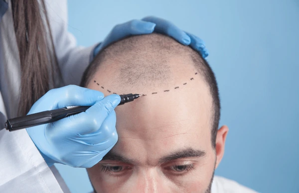 hairloss treatment