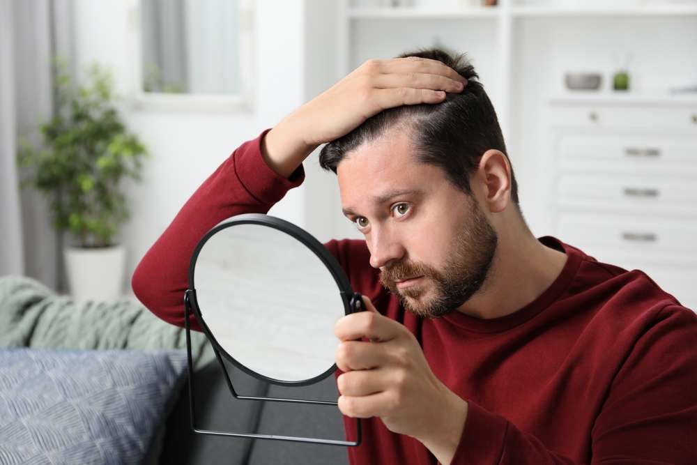 bad hairline