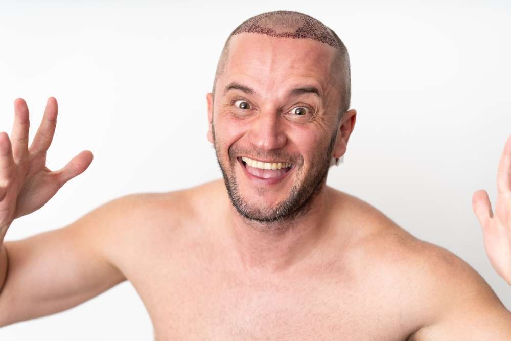 finasteride vs minoxidil
